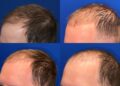 Can You Reverse A Hair Transplant?