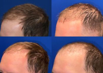 Can You Reverse A Hair Transplant?