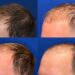 Can You Reverse A Hair Transplant?