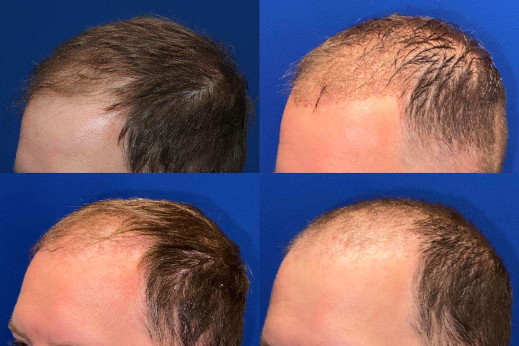 can-you-reverse-a-hair-transplant